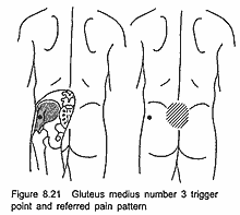 likely trigger point in the gluteus